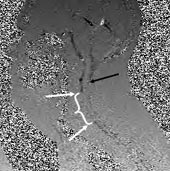 Cerebrospinal Fluid Flow (CSF) Studies