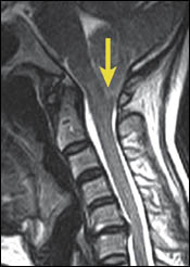 Chiari Malformation Visualization When Upright