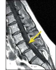 Evaluation of Spinal Instability