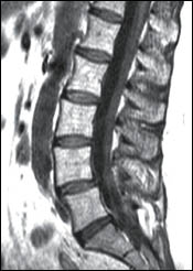 Evaluation of Spinal Instability