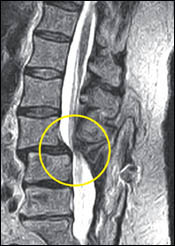 Postoperative Hypermobile Instability