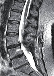 Postoperative Hypermobile Instability