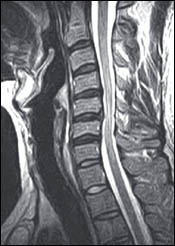 Upright Dynamic MRI Reveals Hidden Disc Herniation