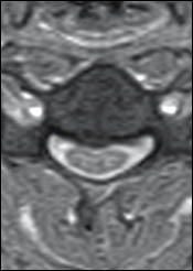 Upright Dynamic MRI Reveals Hidden Disc Herniation
